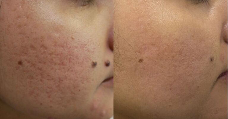 Acne Scars Treatment