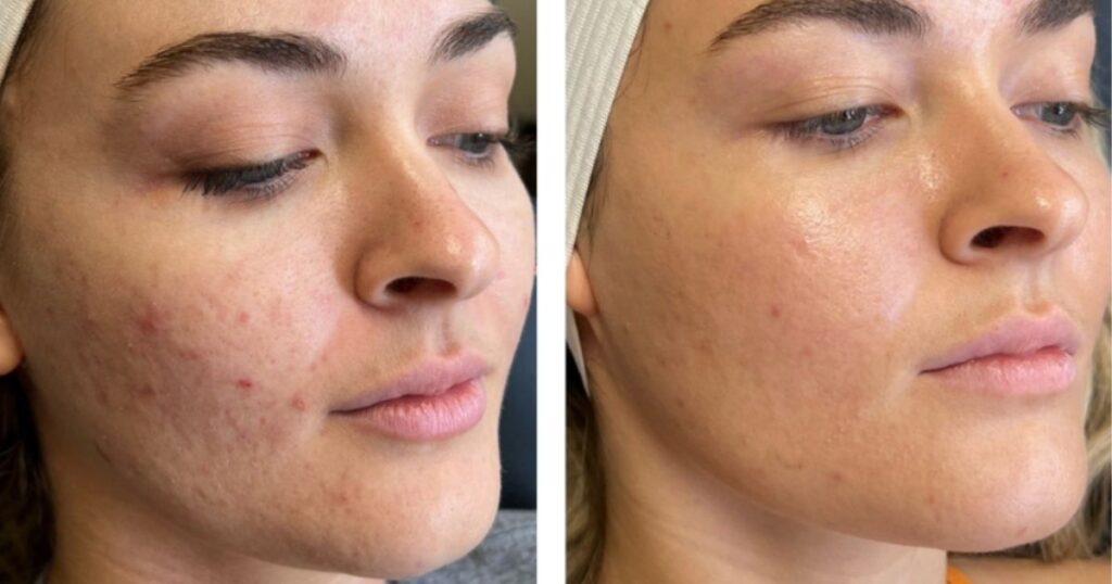 Chemical Peels for Acne Scar Resurfacing